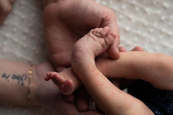 Close-up of newborn baby's tiny club foot resting in a parent's hand